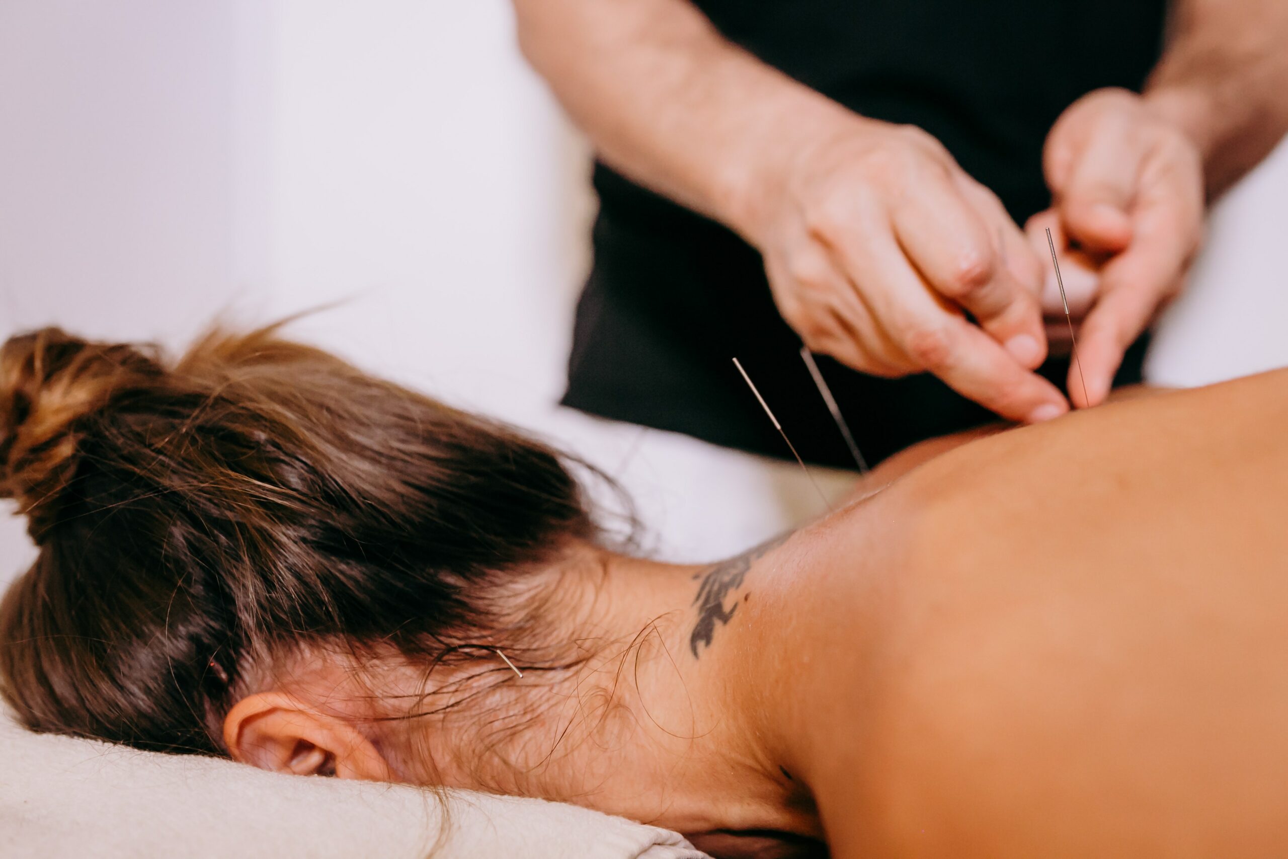 Hands Inserting Needles on the Person's Back